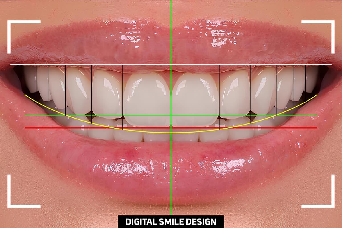 Estetica Dentale - Top Dental Torino