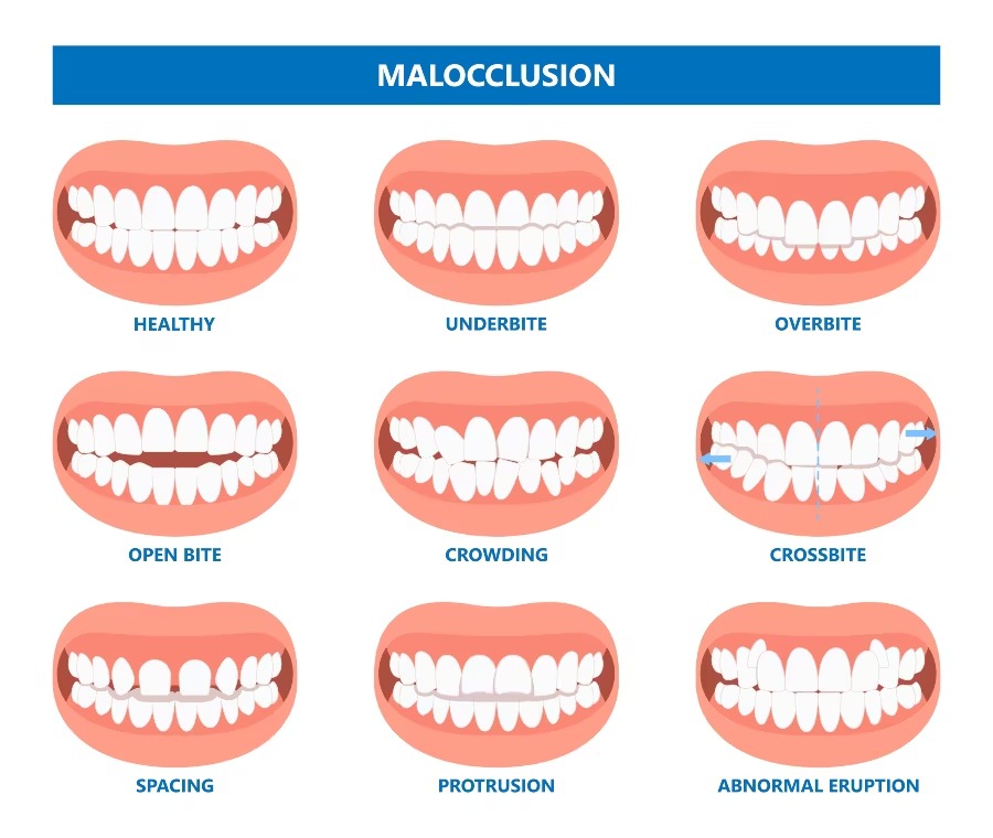 Malocclusione dentale esempio